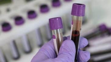 Do All Private Exams fix the Anion Gap?