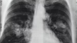 HPV lung cancer test kit and lung test at home MBMC