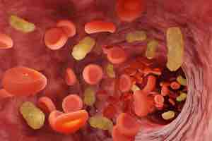 Rises in the Threat of Sepsis MBMC