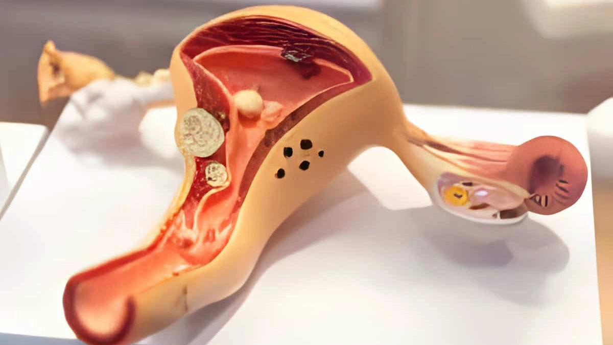 What are the Causes of Diseases of the Cervix? MBMC